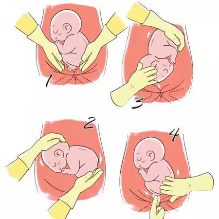 前置胎盘,脐带绕颈这些禁忌证,经改变体势或其他方法纠正无效的准妈妈