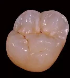 二氧化锆全瓷牙的七大优势