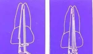 牙胶尖什么颜色口腔精读 ｜ 根管填充你真的做对了吗？看看这篇文章！_https://www.jmylbn.com_新闻资讯_第9张