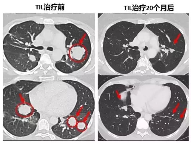 當1400億個免疫細胞進入體內，如何成功殲滅7個腫瘤 健康 第10張