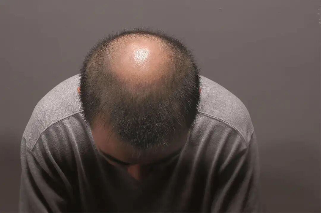 为什么雄脱总是前面和头顶的头发开始变少