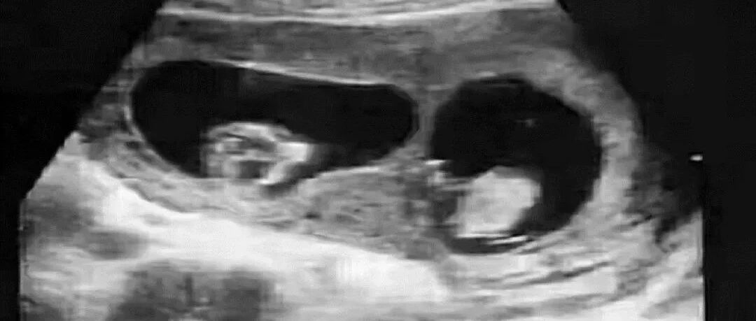 DNA鉴定孩子是叔叔的，可爸爸是独生子！怎么回事？