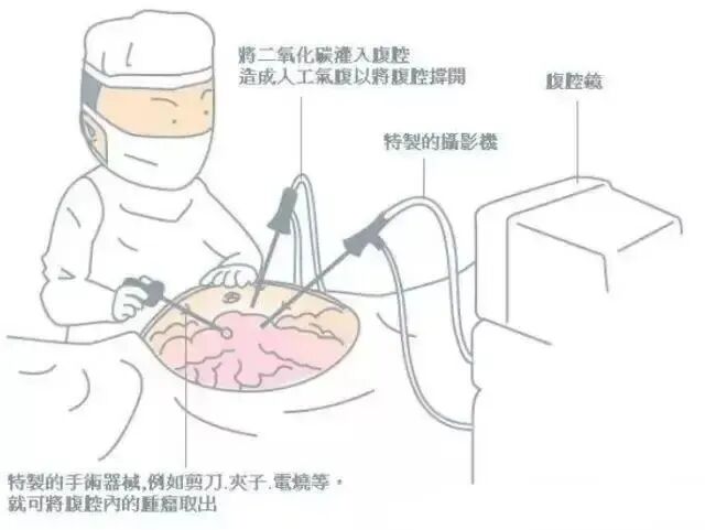 气腹管怎么接技术 ｜ 腹腔镜手术中CO2气腹管理_https://www.jmylbn.com_新闻资讯_第7张
