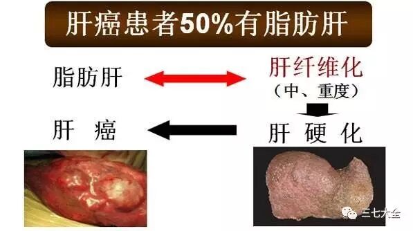 正确认识脂肪肝，三七花能帮上大忙！