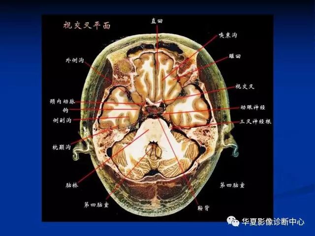 完整的头颅mri解剖