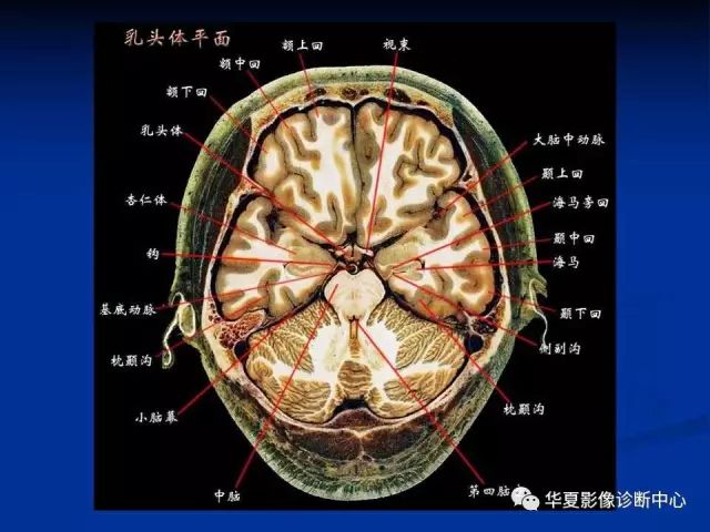 完整的头颅mri解剖