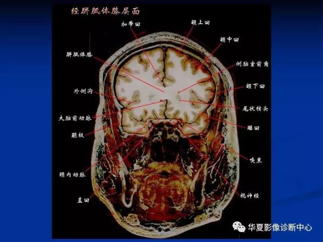 完整的头颅mri解剖