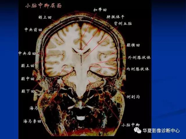完整的头颅mri解剖