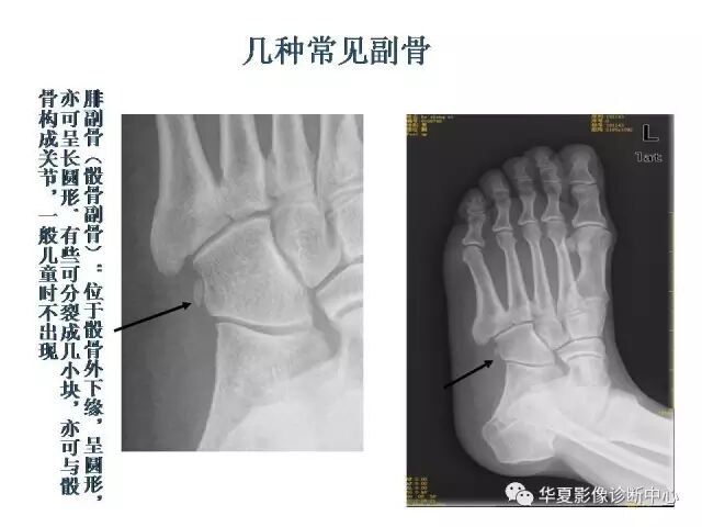 再骨的生长发育过程中,当骺板发育到成熟阶段,其软骨的增殖和成骨活动
