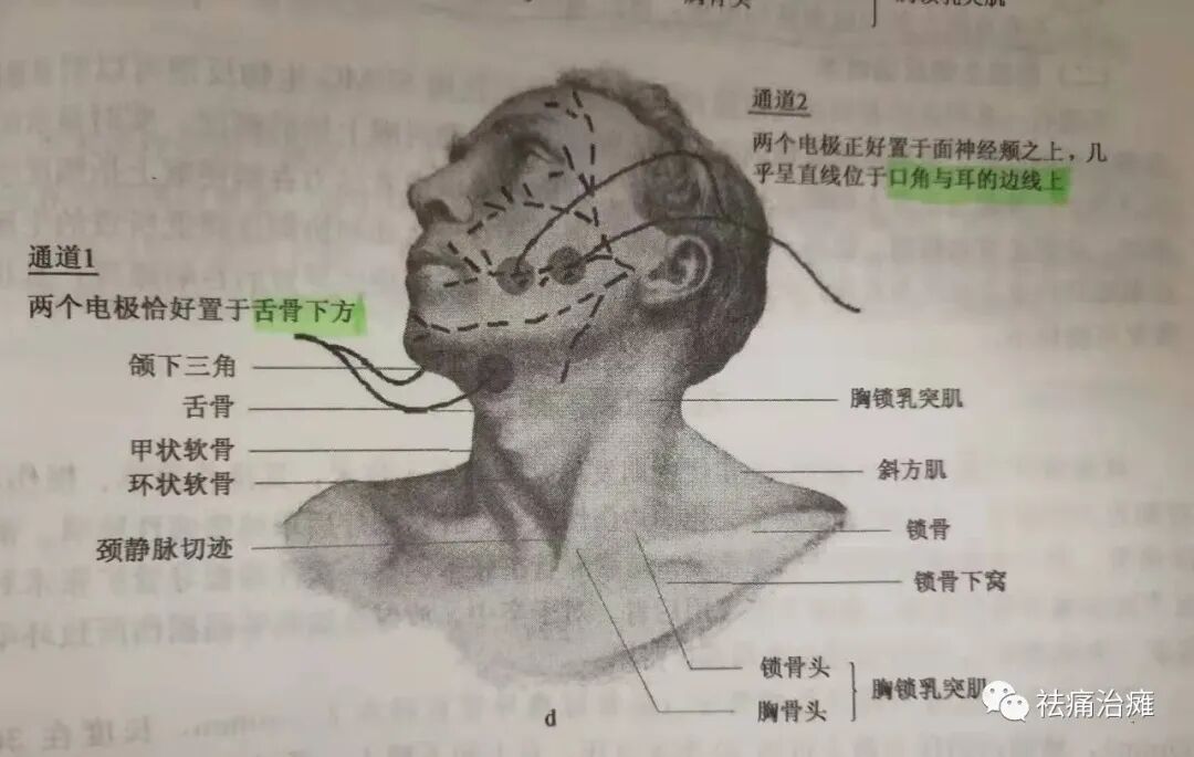 为什么要做吞咽仪器《康复科那些仪器》----“吞咽机”_https://www.jmylbn.com_新闻资讯_第12张