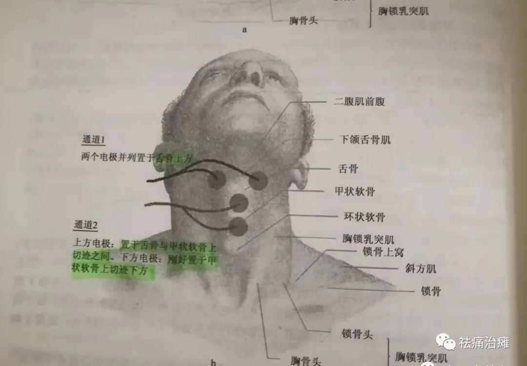 为什么要做吞咽仪器《康复科那些仪器》----“吞咽机”_https://www.jmylbn.com_新闻资讯_第10张