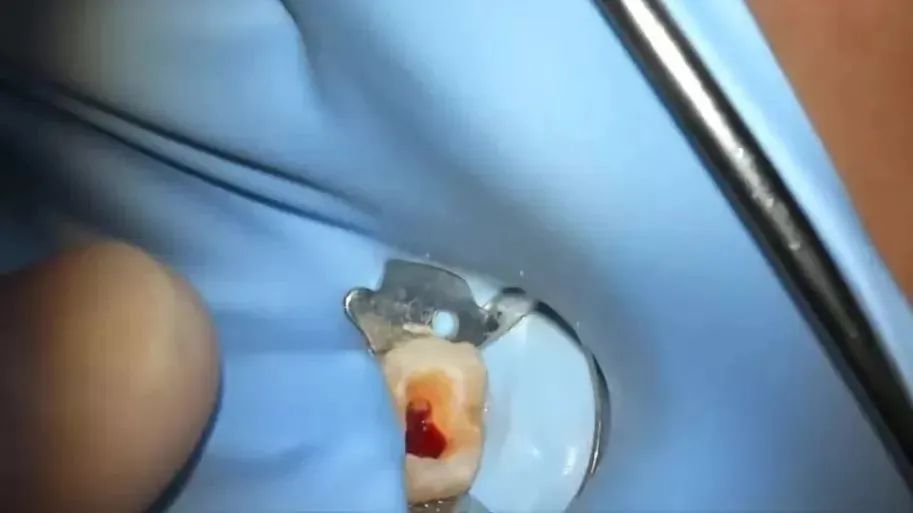 树脂补牙的临床常见问题处理