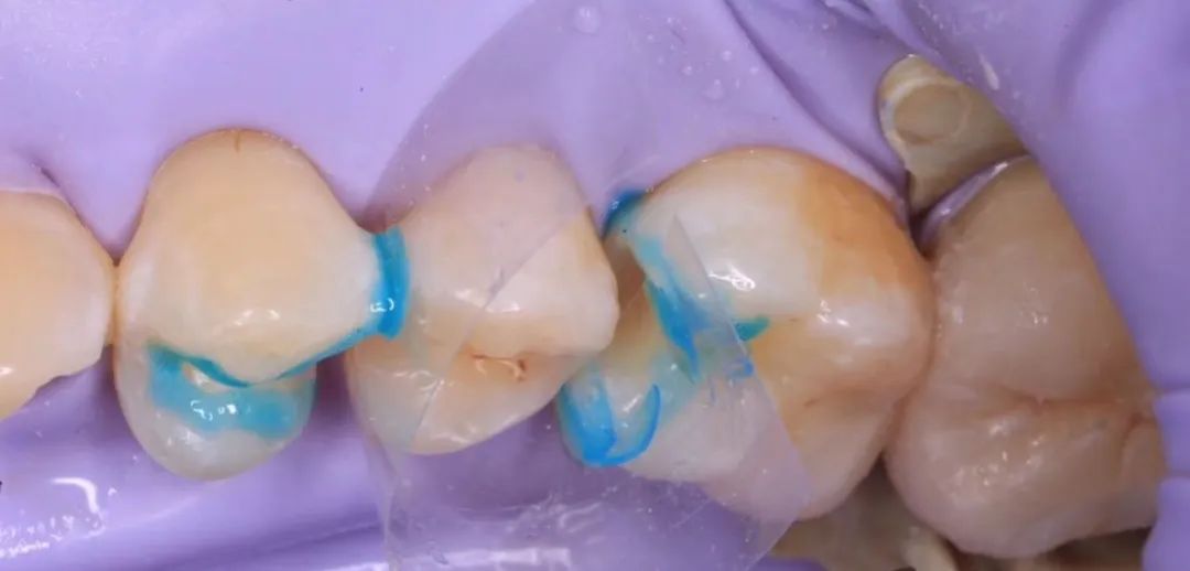 树脂补牙的临床常见问题处理