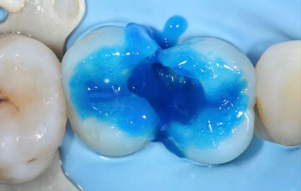 树脂补牙的临床常见问题处理