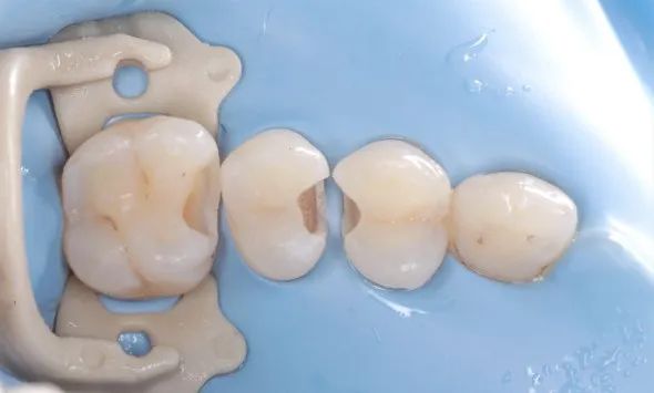 树脂补牙的临床常见问题处理