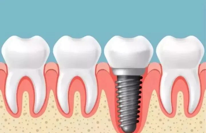 详解种植牙全过程，看完都放心种牙了！