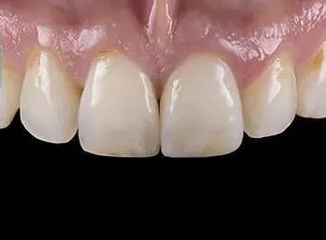 全瓷修复的几个注意点