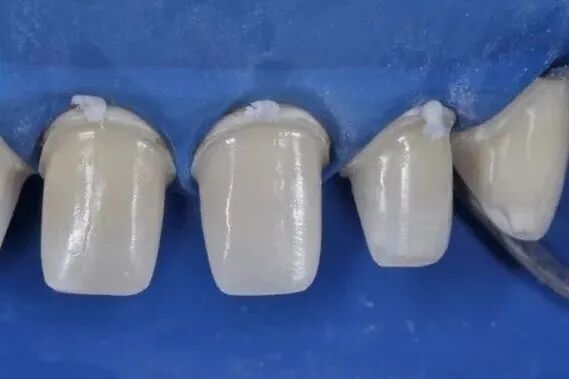 全瓷修复的几个注意点