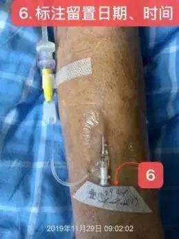bd留置针怎么使用7大留置针固定要点，操作考试必掌握！_https://www.jmylbn.com_新闻资讯_第25张