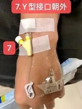 bd留置针怎么使用7大留置针固定要点，操作考试必掌握！_https://www.jmylbn.com_新闻资讯_第17张