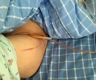 为什么新尿袋会漏尿你患者的尿管漏尿了吗？看过来~_https://www.jmylbn.com_新闻资讯_第1张