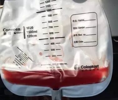 为什么新尿袋会漏尿你患者的尿管漏尿了吗？看过来~_https://www.jmylbn.com_新闻资讯_第3张