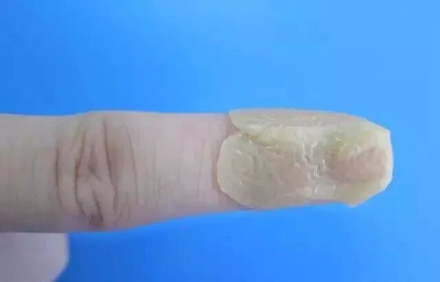 伤口贴敷料为什么护士，你贴的敷贴又卷边了？这里有八种敷贴固定技巧_https://www.jmylbn.com_新闻资讯_第9张