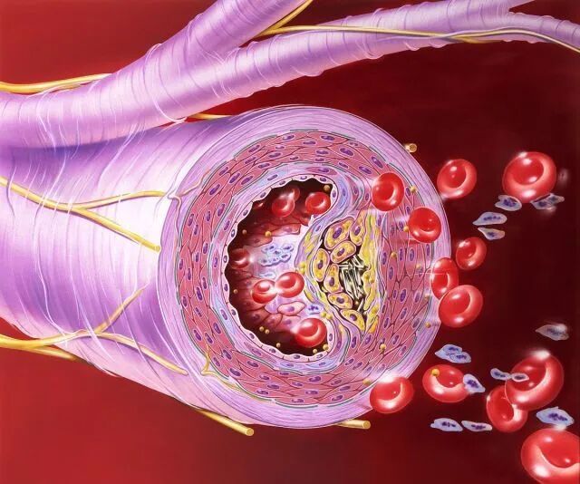动脉硬化怎么检测体检科普｜血管硬化的“照妖镜”——动脉硬化检测仪_https://www.jmylbn.com_新闻资讯_第2张