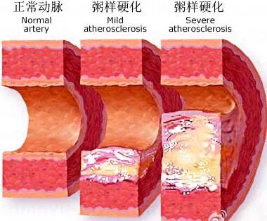 动脉硬化怎么检测体检科普｜血管硬化的“照妖镜”——动脉硬化检测仪_https://www.jmylbn.com_新闻资讯_第1张