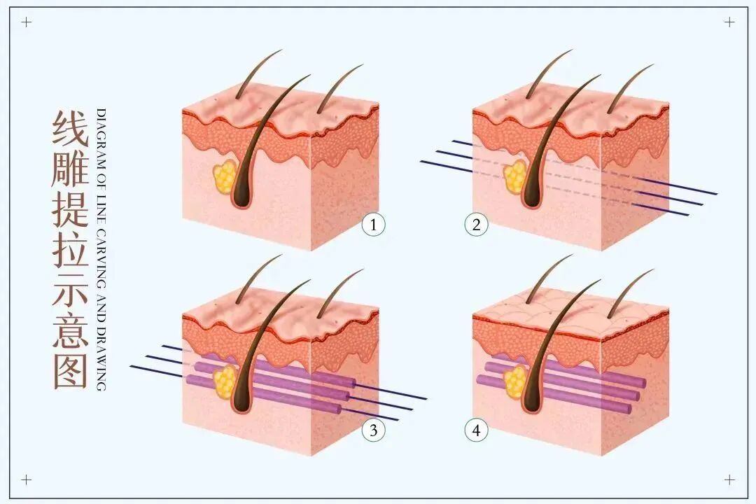 pga和pgla有什么区别早读 ｜ 线雕干货！5大角度深度讲解_https://www.jmylbn.com_新闻资讯_第1张