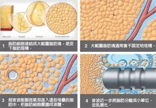 潘红伟医生面部吸脂与修复优势
