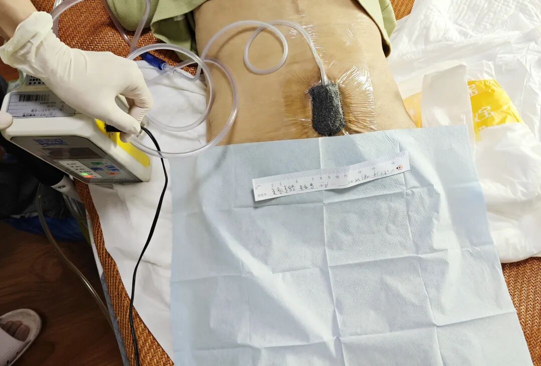 广东褥疮怎么治疗家有压疮老人，不知如何照顾怎么办？_https://www.jmylbn.com_新闻资讯_第4张