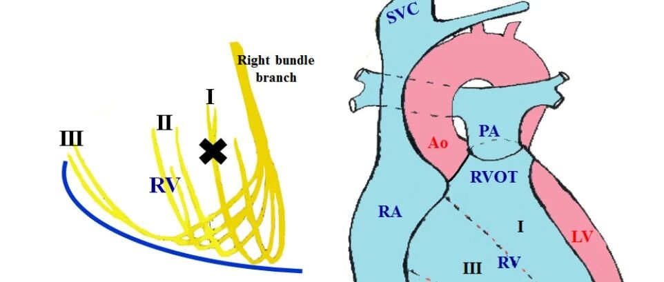 早读 | 左前分支阻滞大家都熟悉，那么右上分支呢？