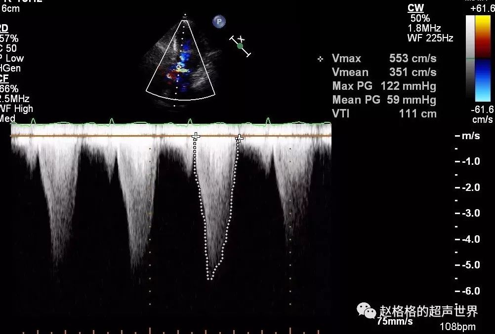 sam征超声表现图像图片