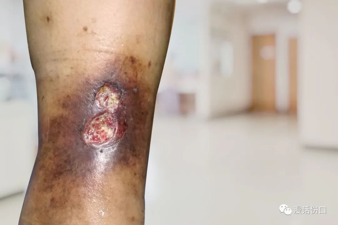 压力绷带为什么那么贵下肢静脉溃疡（老烂腿）_https://www.jmylbn.com_新闻资讯_第1张