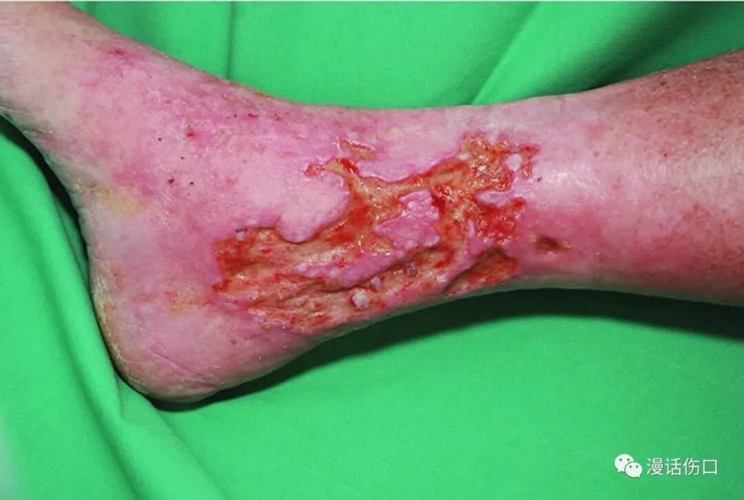 压力绷带为什么那么贵下肢静脉溃疡（老烂腿）_https://www.jmylbn.com_新闻资讯_第2张