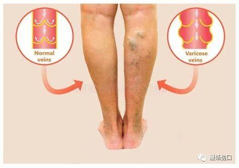 压力绷带为什么那么贵下肢静脉溃疡（老烂腿）_https://www.jmylbn.com_新闻资讯_第4张