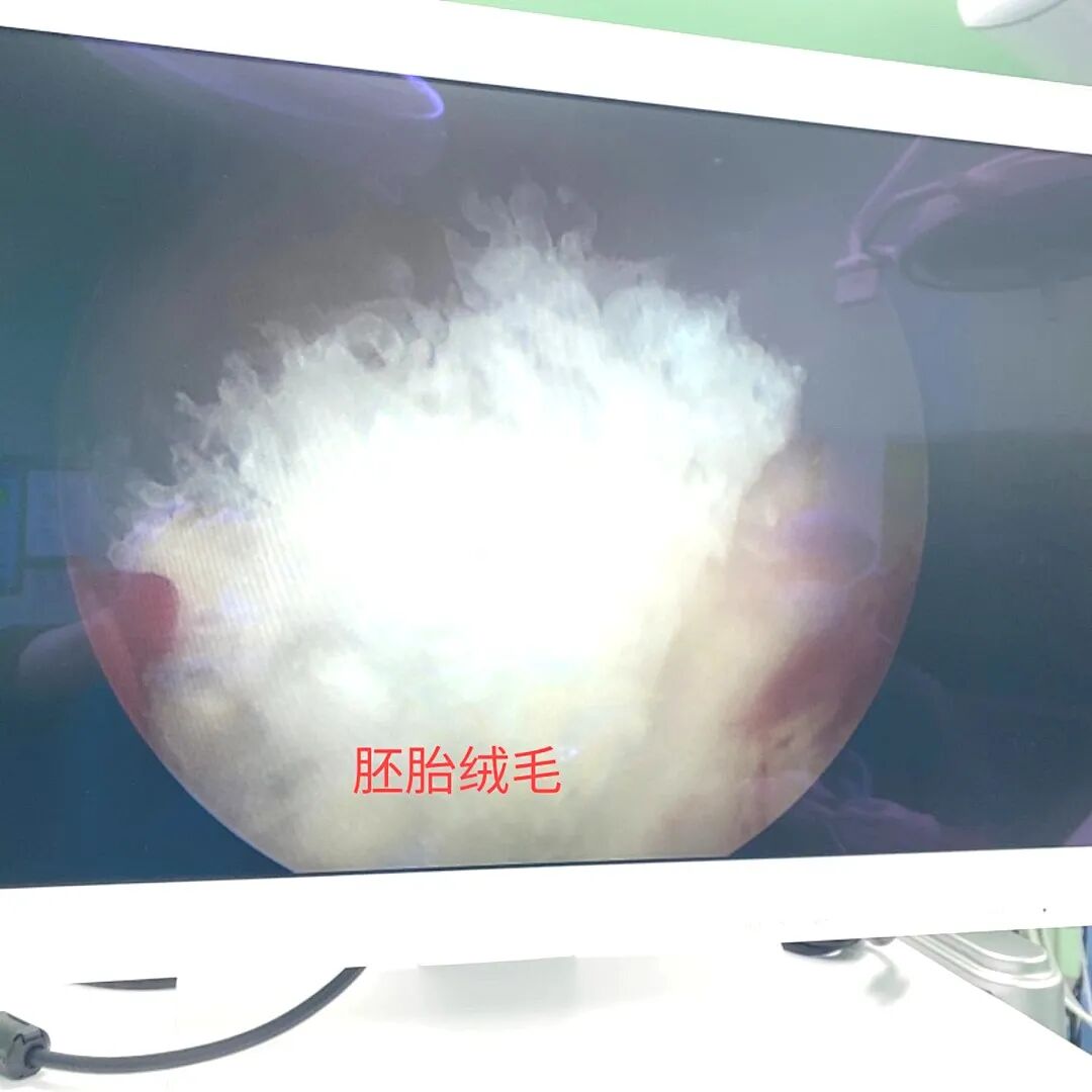 什么是电吸人流宫腔镜电吸人流手术，为什么越来越多的女性选择？_https://www.jmylbn.com_新闻资讯_第5张