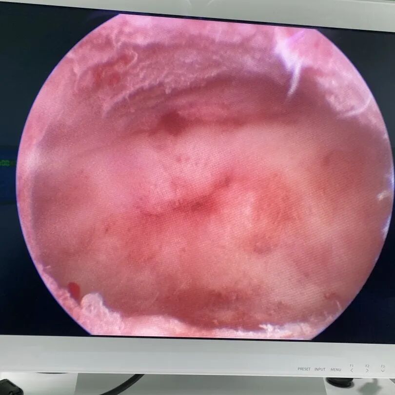 什么是电吸人流宫腔镜电吸人流手术，为什么越来越多的女性选择？_https://www.jmylbn.com_新闻资讯_第6张