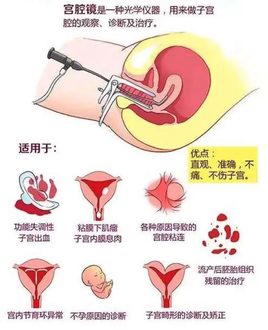 什么是电吸人流宫腔镜电吸人流手术，为什么越来越多的女性选择？_https://www.jmylbn.com_新闻资讯_第8张