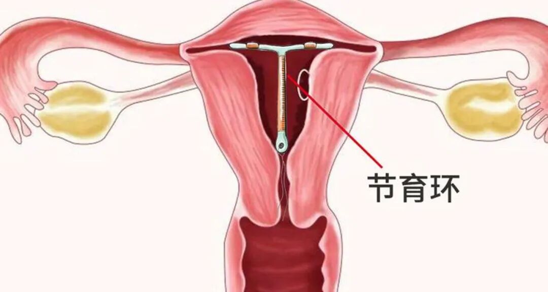 宫颈器怎么使用宫颈节育器就是环，有寿命！忘了取，有伤害！_https://www.jmylbn.com_新闻资讯_第2张
