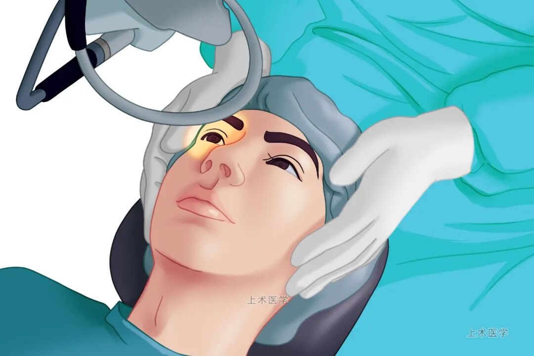 近视眼想去做手术?看完本文再决定也不迟