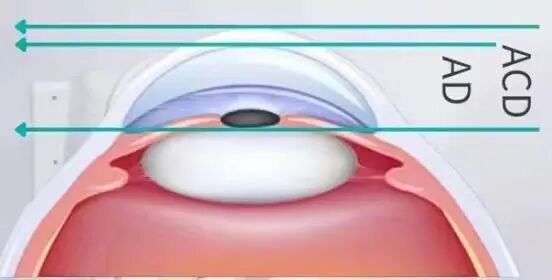 怎么测角膜直径眼视光中心丨一起了解眼球生物学测量_https://www.jmylbn.com_新闻资讯_第18张