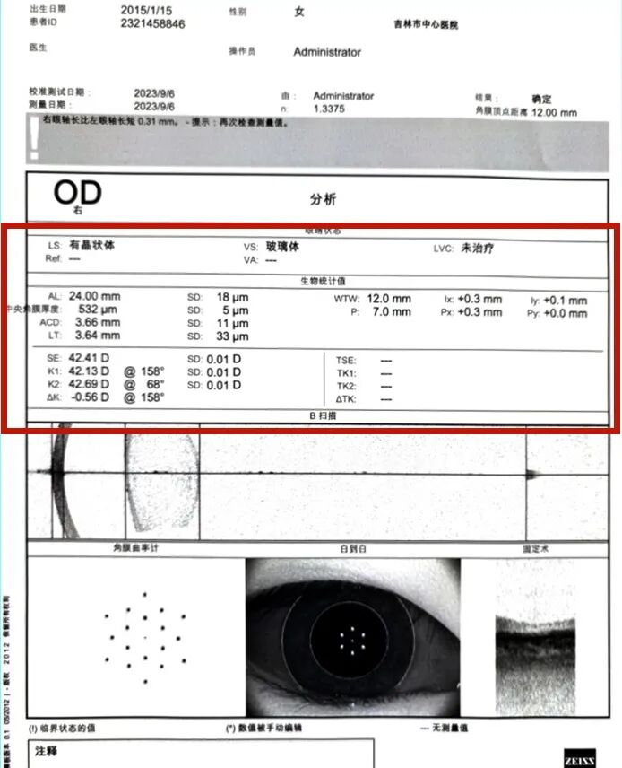 怎么测角膜直径眼视光中心丨一起了解眼球生物学测量_https://www.jmylbn.com_新闻资讯_第12张