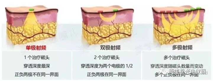 多极射频是什么美容项目射频与热玛吉（一）_https://www.jmylbn.com_新闻资讯_第4张