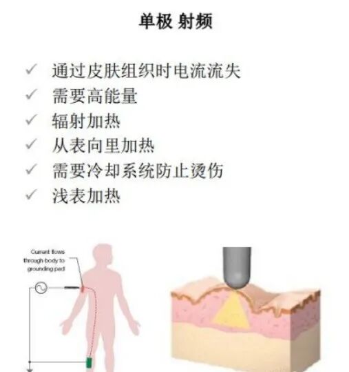 多极射频是什么美容项目射频与热玛吉（一）_https://www.jmylbn.com_新闻资讯_第2张