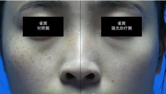 皮肤管理 色素沉着 真的伤不起 新美业光电仪器 二十次幂