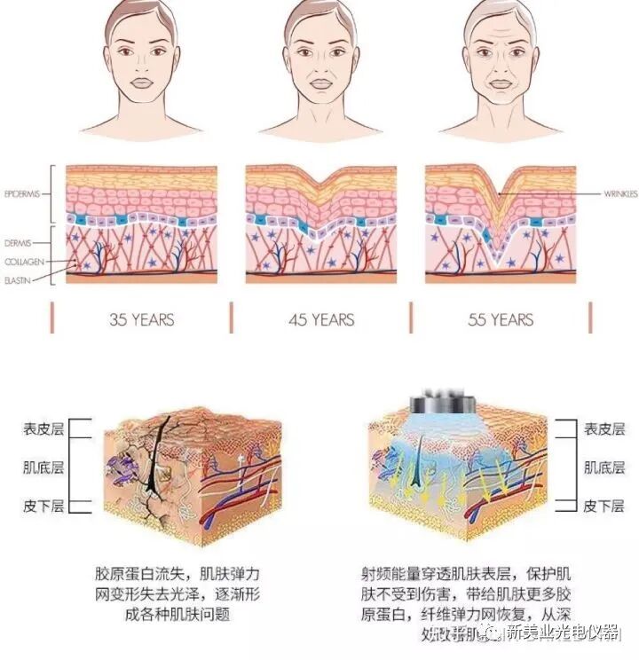 多极射频是什么美容项目射频与热玛吉（一）_https://www.jmylbn.com_新闻资讯_第1张