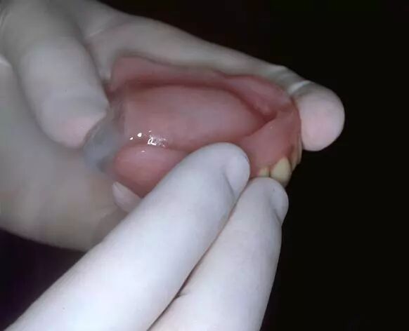 牙科材料硅胶怎么用软衬材料的应用及操作案例_https://www.jmylbn.com_新闻资讯_第12张