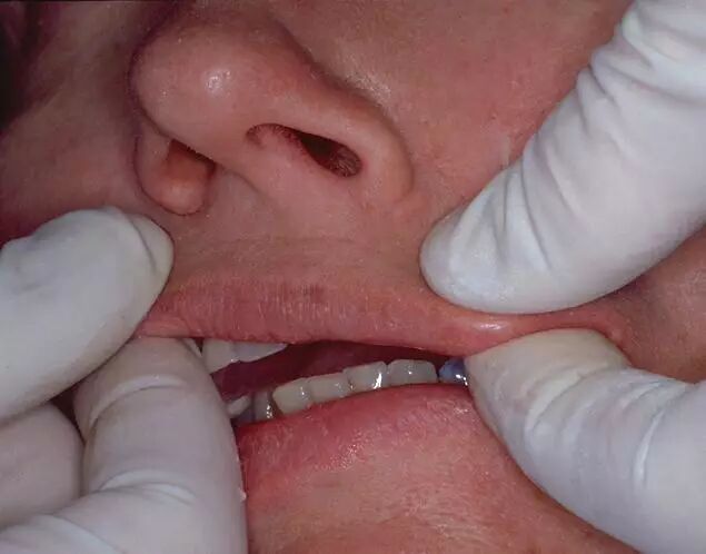 牙科材料硅胶怎么用软衬材料的应用及操作案例_https://www.jmylbn.com_新闻资讯_第11张